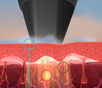 Body & Soul Clinic: Laser Treatment for Hair Removal	