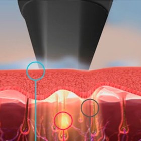 Body & Soul Clinic: Laser Treatment for Hair Removal	